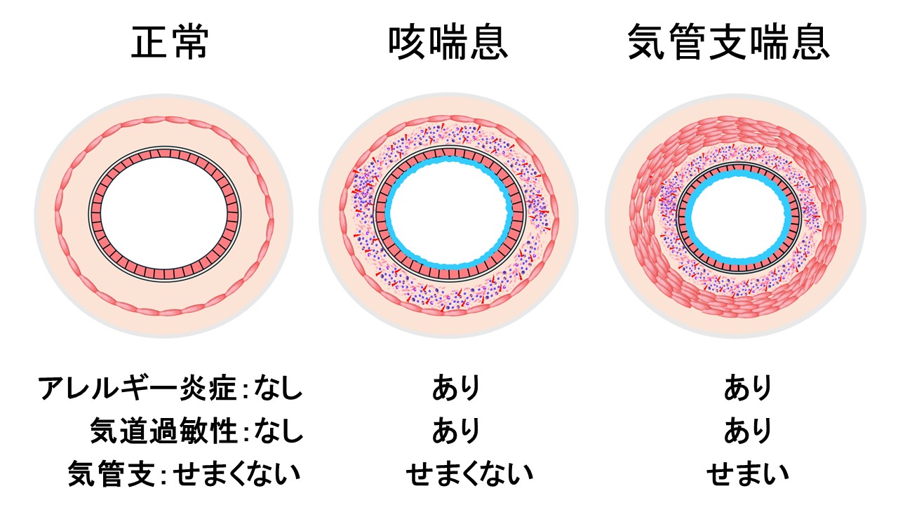 【気道断面図】正常、咳喘息、気管支喘息の違い
