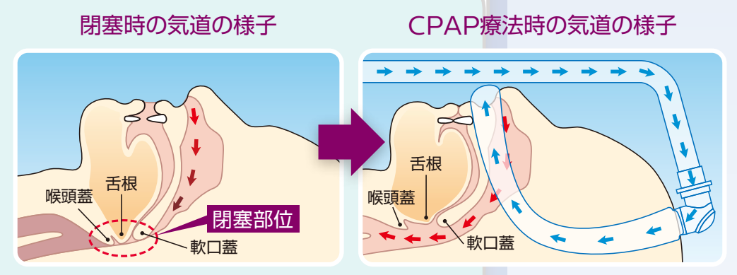 CPAP治療のイメージ