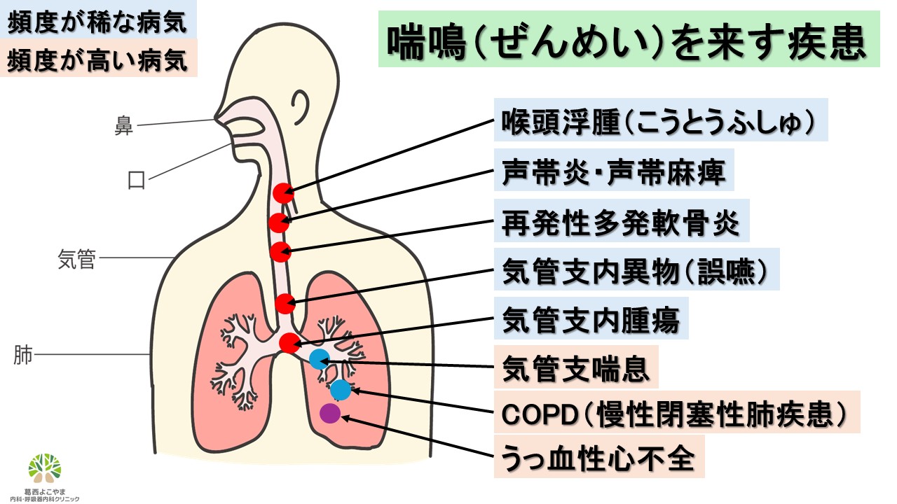 喘鳴を来す疾患