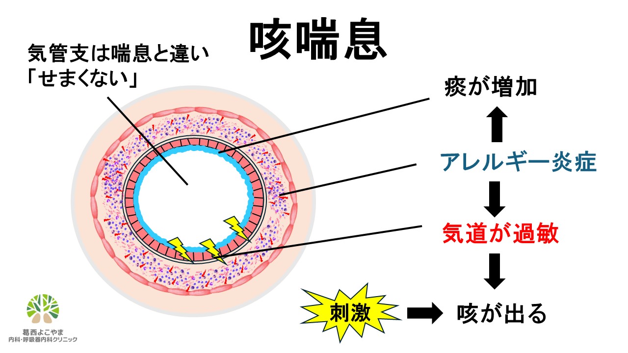 【イラスト図解】咳喘息とは