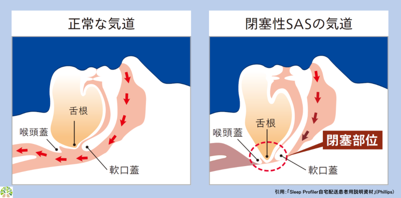 睡眠時無呼吸症候群 