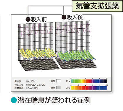 気道抵抗の変化