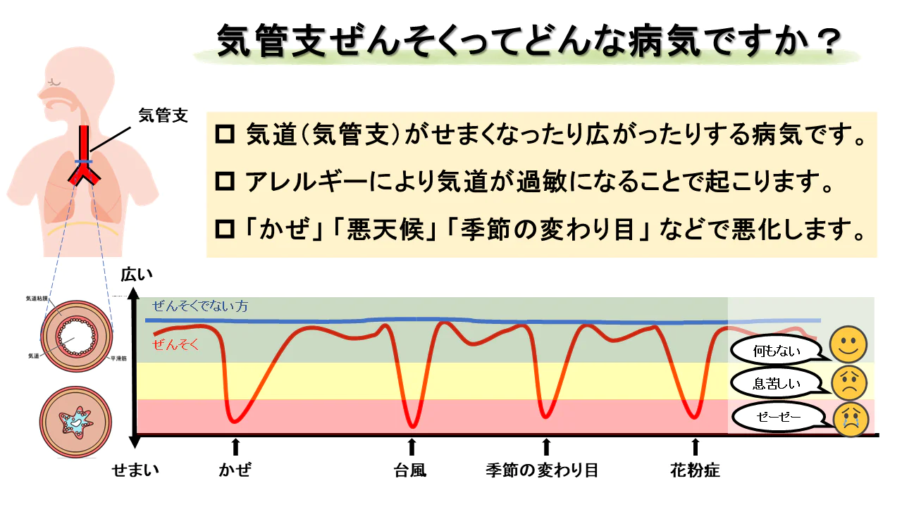 気管支ぜんそくはどんな病気か：喘息が悪化する要因と気管支の伸び縮みを表すことで表現